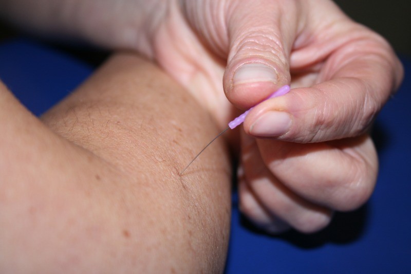 Dry needling