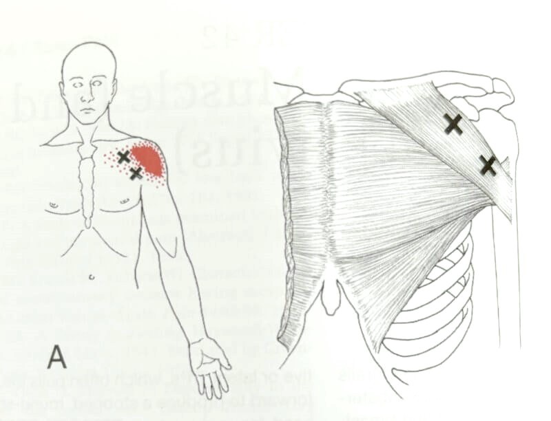 praktijk-fysio-zeeland-spierknopen-triggerpoints Triggerpoints, spierknopen met en zonder uitstraling
