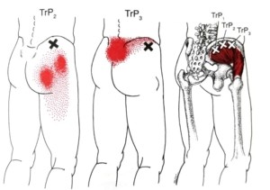 praktijk-fysio-zeeland-triggerpoints-bil