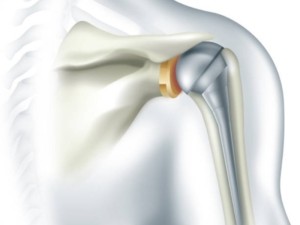 Fysiotherapie na een schouderprothese, waar moet je dan aan denken?